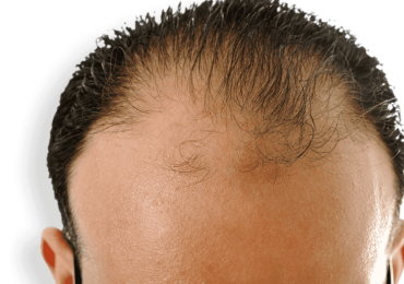 Kiến thức về rụng tóc: Nguyên nhân, cách điều trị và ngăn ngừa