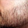 Tìm hiểu 6 nguyên nhân gây rụng râu và cách khắc phục