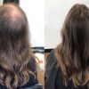 Rụng tóc ở nam, nữ: Nguyên nhân và cách khắc phục