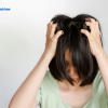 Giải đáp thắc mắc nấm da đầu có gây rụng tóc không?