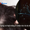 Tóc rụng có hạt trắng ở chân tóc là do đâu?
