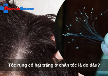 Tóc rụng có hạt trắng ở chân tóc là do đâu?