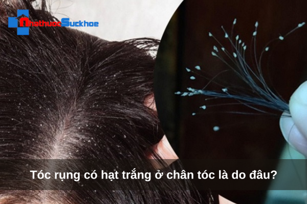 Tóc rụng có hạt trắng ở chân tóc là do đâu?