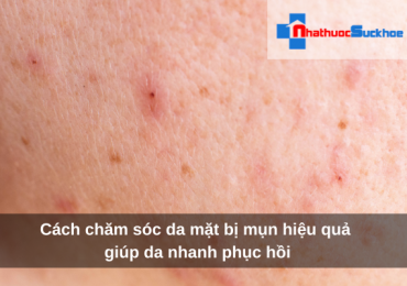 Cách chăm sóc da mặt bị mụn hiệu quả giúp da nhanh phục hồi