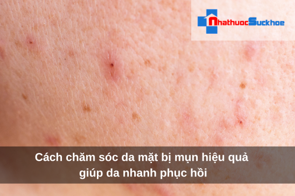 Cách chăm sóc da mặt bị mụn hiệu quả giúp da nhanh phục hồi