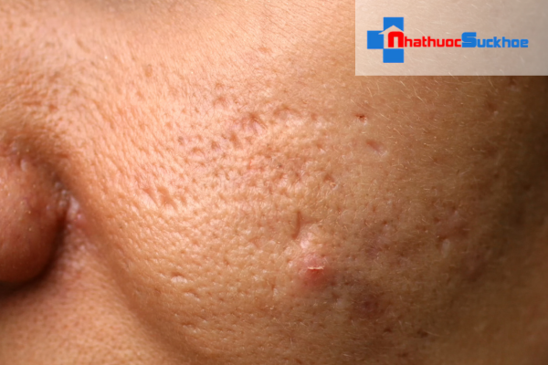 Đặc điểm của da dầu mụn