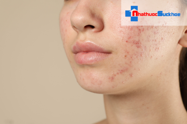 Nguyên tắc chăm sóc da dầu mụn hiệu quả