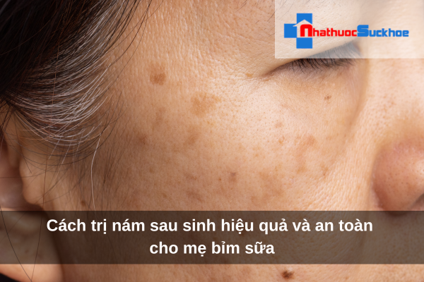 Cách trị nám sau sinh hiệu quả và an toàn cho mẹ bỉm sữa