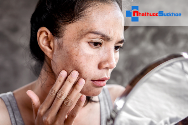 Cách trị nám sau sinh từ bên ngoài